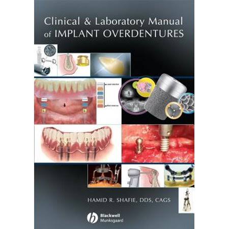 Implant Overdentures Manual eBook A666813